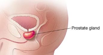 Enlarged Prostate: Partnering with Your Doctor and My Everything Store for the Right Catheter - My Everything Store