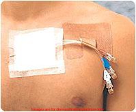 Cath Strip Reclosable Catheter FastenerDerma Science